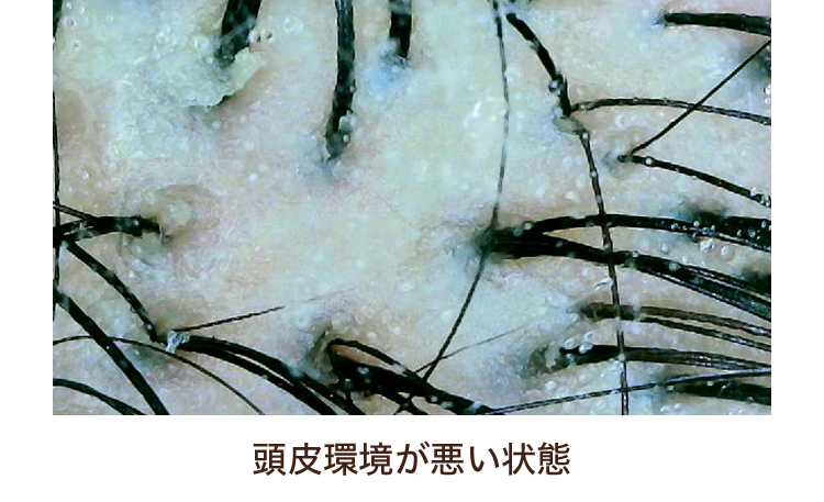 頭皮環境が悪い状態